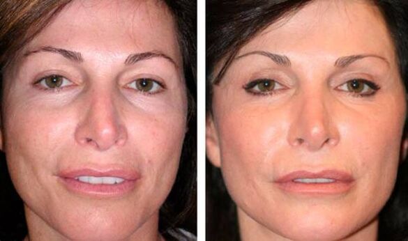 photo after plasma facial skin rejuvenation