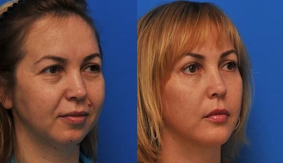 with skin firming photo before and after rejuvenation 1
