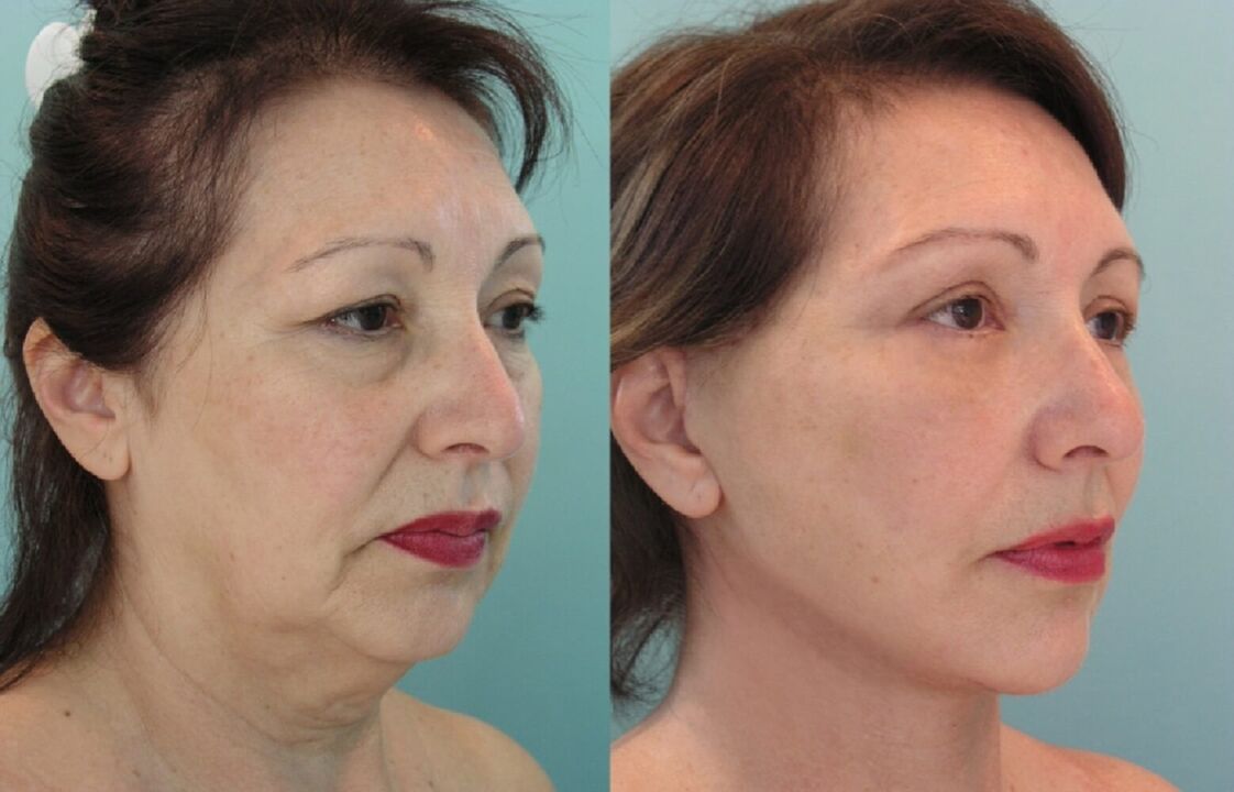 Before and after thread facelifting