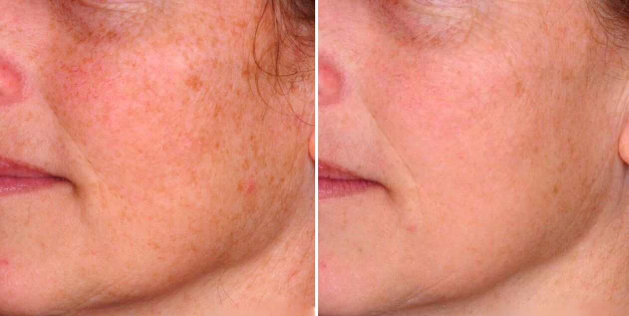 Fractional photothermolysis results in a reduction in age spots on the skin of the face. 