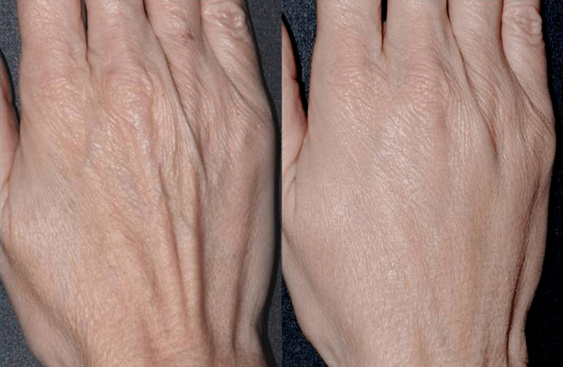contour plastic, hand rejuvenation 2. photo before and after