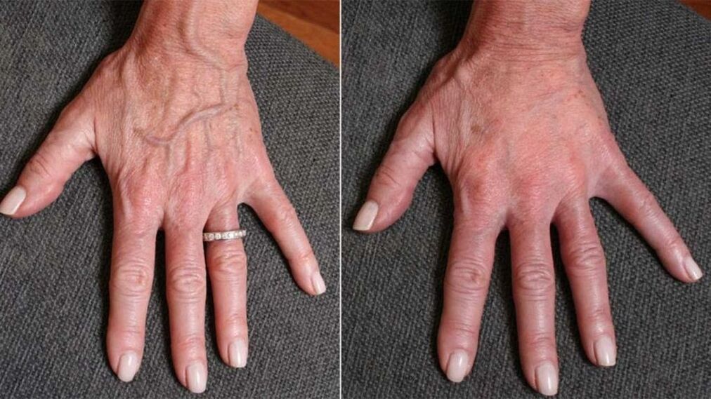 contour plastic, hand rejuvenation photo 1 before and after