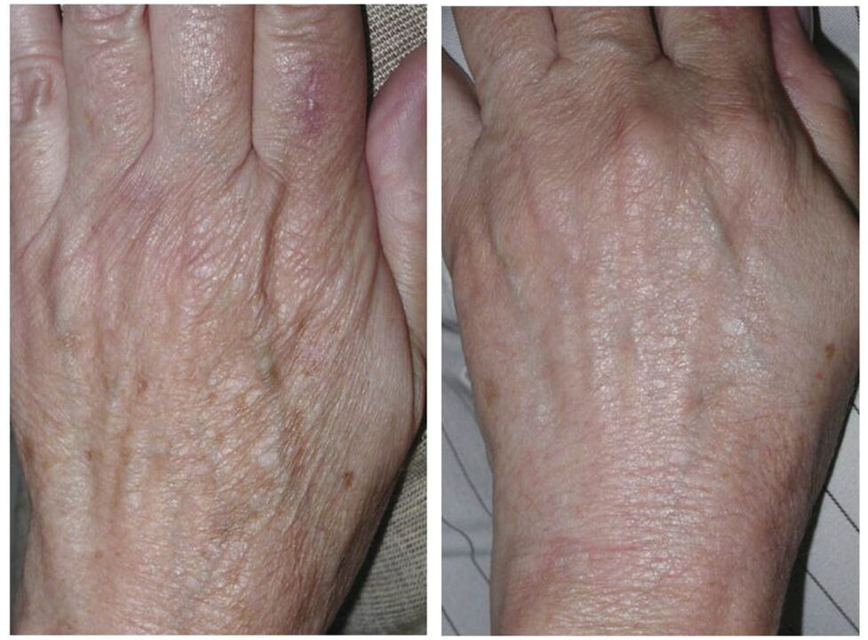 laser hand rejuvenation before and after images
