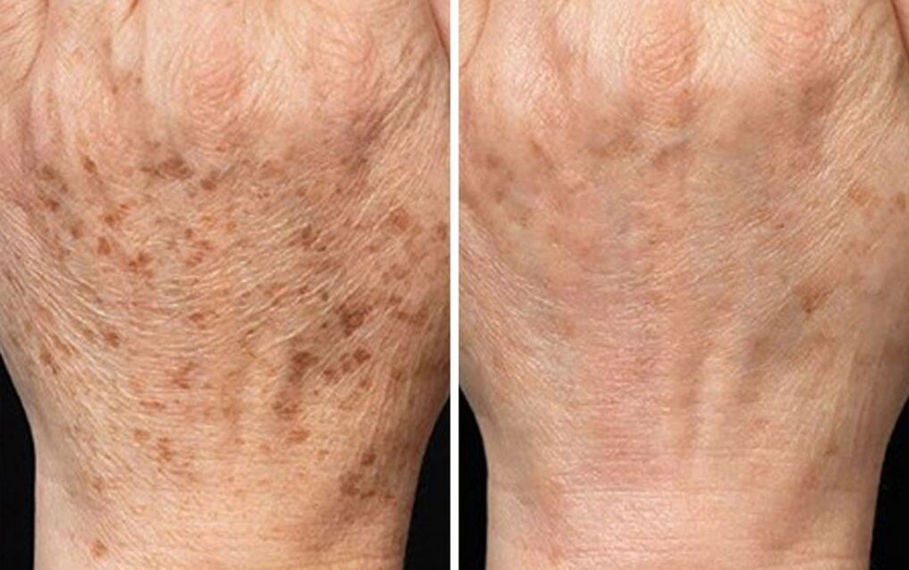 peeling hands before and after pictures